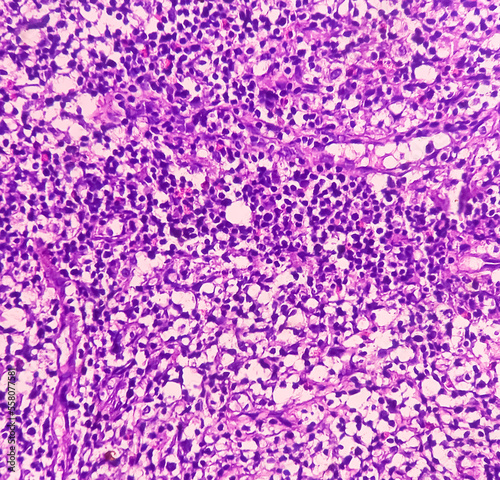 Fototapet Lymph node (biopsy): Hodgkin's lymphoma, mixed cellularity, monotonous population of lymphocytes, histiocytes, plasma cell, large mononuclear cells