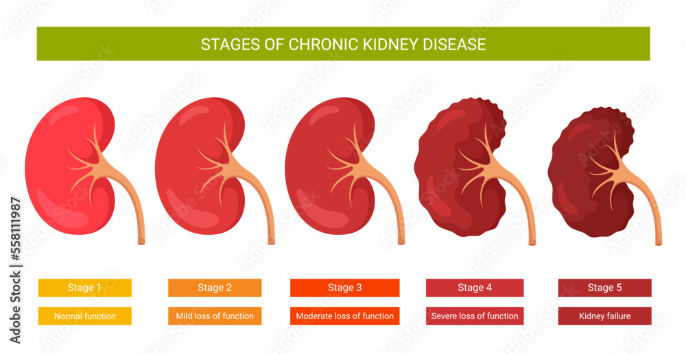 Infographics stages of chronic kidney disease stock vector adobe stock