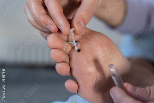Alternative home treatment of verruca foot. Man applying liquid celandine extract on the wart plantar of his foot. Human papilloma callus virus or HPV  viral skin infection concept. 