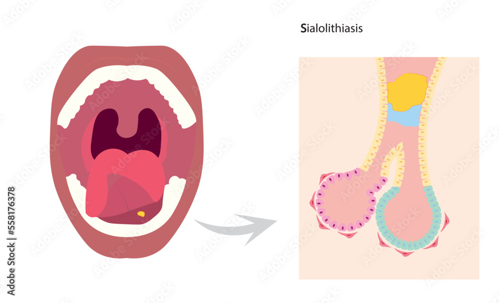 Sialolithiasis Salivary Duct Obstruction Due To A Salivary Stone Sialolithiasis Salivary Duct Obstruction Due To A Salivary Stone