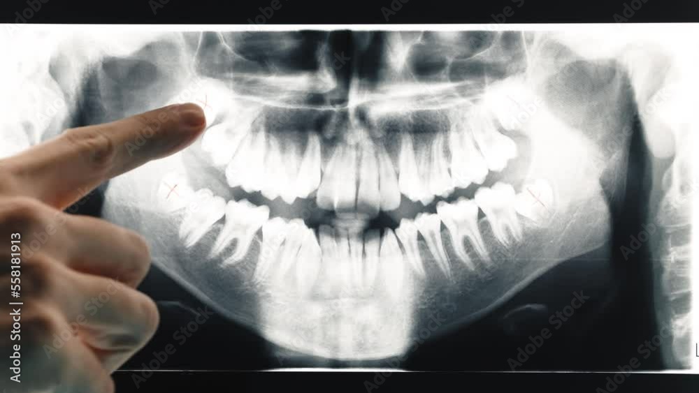 Hand of a dentist analyzes the x-rays of the teeth
