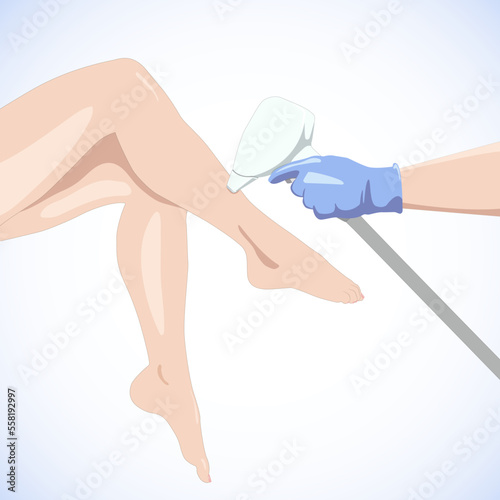Illustration.Elos epilation, hair removal procedure on a woman’s body. Beautician doing laser rejuvenation in a beauty salon. Removing unwanted body hair.	