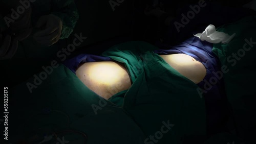 A middle-aged woman who had stem cells removed from her abdomen and legs during plastic surgery.