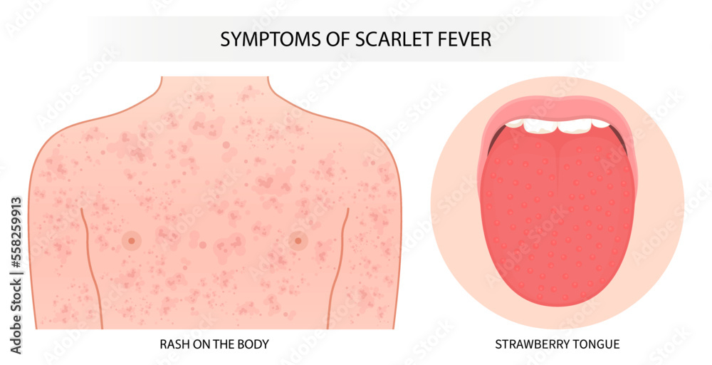 Sunburn body neck trunk children and tongue bacterial Infectious kidney