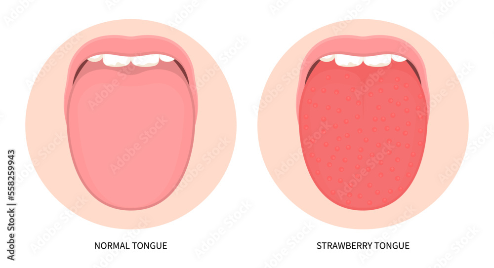Tongue bacterial Infectious red swelling body children lines sunburn