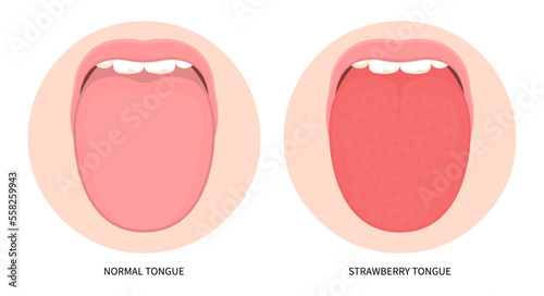 Tongue bacterial Infectious red swelling body children lines sunburn face neck trunk Flushed group a toxin sore kidney