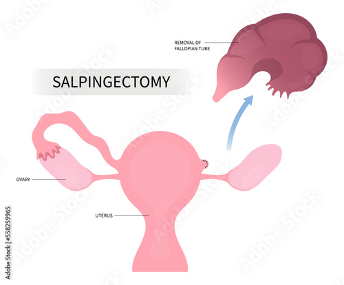 Pelvic cancer tumor disease anatomy uterus pain surgical biopsy hormone tube birth ovary tubal cyst contraceptive BRCA Salpingo gene mutation Tubo Blocked IVF In Vitro total female C Cesarean section