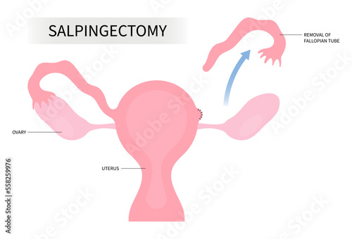 Anatomy uterus pain surgical biopsy hormone tube cancer tumor birth ovary tubal cyst contraceptive BRCA gene mutation Tubo Blocked IVF In Vitro total female C Cesarean section Salpingo pelvic disease