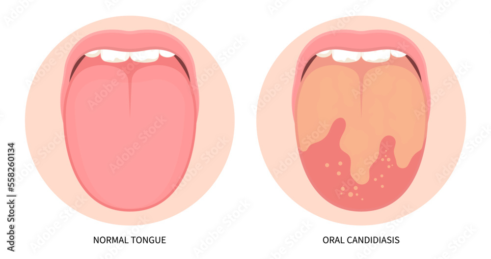 Mouth fungal throat tonsils inflamed cancer ulcer swelling oral pain