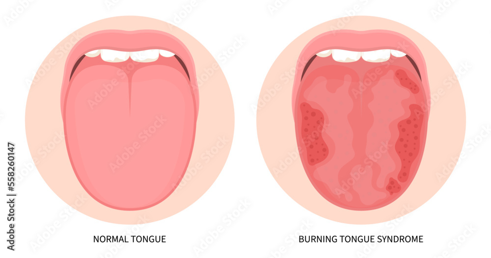 Mouth cancer ulcer swelling oral inflamed pain angular canker sore ...