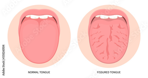 Fissured oral mouth pain cancer ulcer swelling inflamed angular canker sore viral pink trauma burnt throat tonsils gums dry of hunter median celiac iron virus fungal B12 anemia immune system red fever