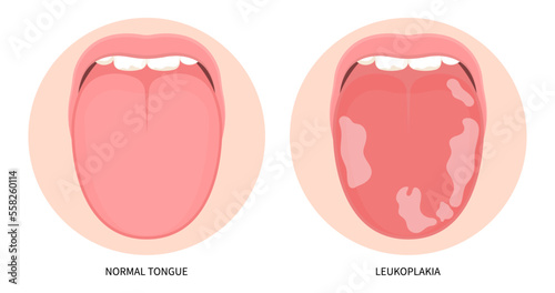 White fungal inflamed in mouth cancer ulcer swelling oral pain angular canker sore viral pink trauma burnt throat tonsils gums dry of hunter median celiac iron virus B12 anemia immune system red fever