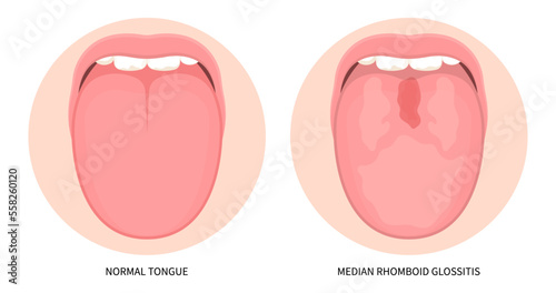 Red fever virus angular in mouth pain cancer ulcer swelling oral inflamed canker sore viral pink trauma burnt throat tonsils gums dry of hunter median celiac iron fungal B12 anemia immune system