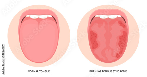 Mouth cancer ulcer swelling oral inflamed pain angular canker sore viral pink trauma burnt throat tonsils gums dry of hunter median celiac iron virus fungal B12 anemia immune system red fever