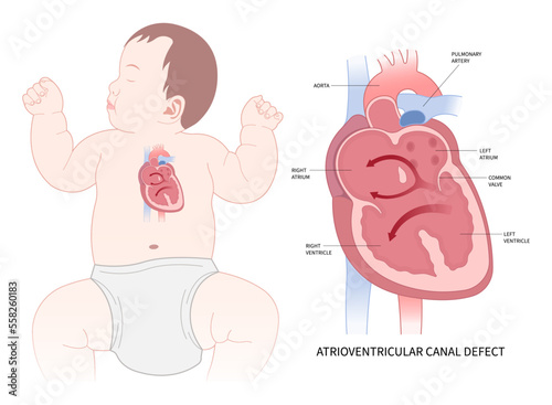 Baby with septum endocarditis congestive pulmonary hypertension photo