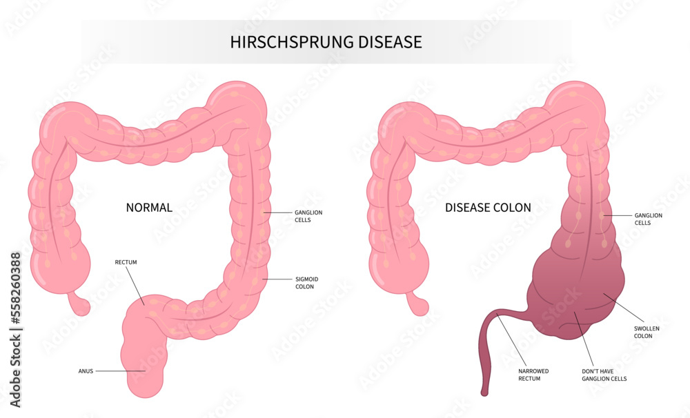 intestinal disease of Hirschsprung's nerves inflammation blocked