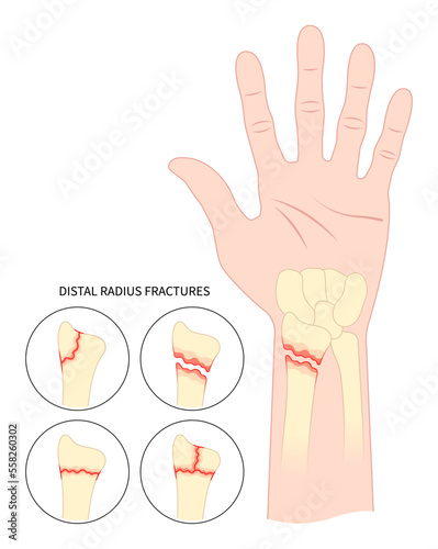 Painful hand break anatomy radial dislocated avascular necrosis displacement fall onto an outstretched closed fragment of dorsal Ulna Extra Intra articular and De quervain's proximal by car pole