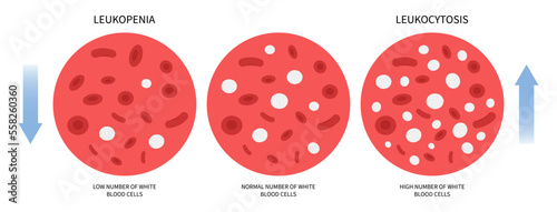 Anemia Basophilia basophils disorder with Low and high white Blood Cell Count for thrombocytosis photo