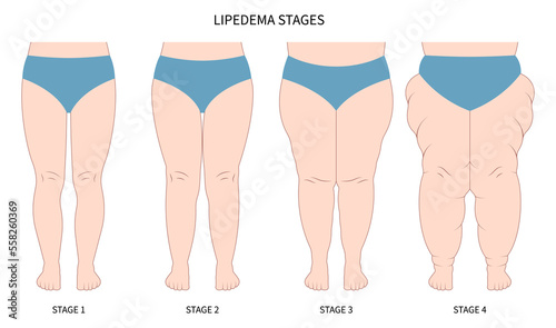 leg lipedema weight loss for Oedema and lipoedema cellulitis