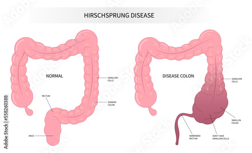 intestinal disease of Hirschsprung's nerves inflammation blocked swollen belly tummy ache sepsis Down keyhole peritonitis incontinence large intestine Diarrhea disorder photo
