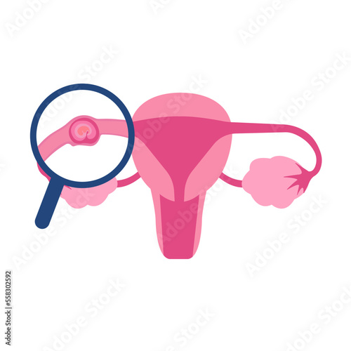 Illustrative image of ectopic pregnancy photo