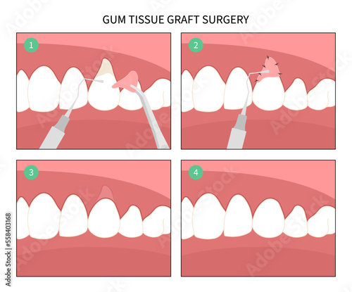 Foto Dentistry crown prep cosmetic recontouring procedure oral teeth pain recession g