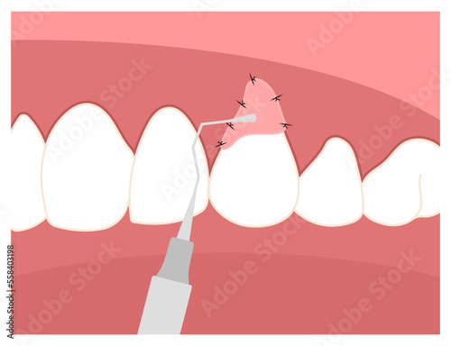 Recession gummy smile dentistry root canal decay toothache swelling Teeth grafting procedure for buildup Loose black cavity abscess oral pain thin injury cosmetic recontouring crown prep