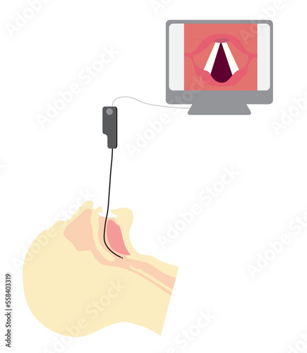 Videolaryngoscopy with vocal cord view in a separeted monitor