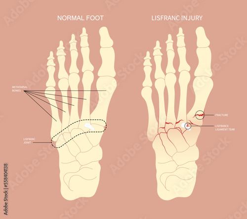 Athletes foot painful with density scan of displaced bone heel toes trauma and Chopart's five