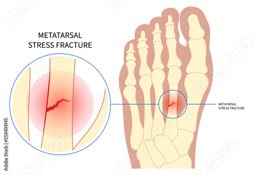 Density scan of foot bone heel toes trauma painful displaced and Chopart's five athletes photo