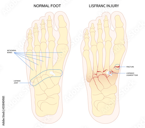 Heel toes bone foot trauma painful displaced and Chopart's five athletes density scan