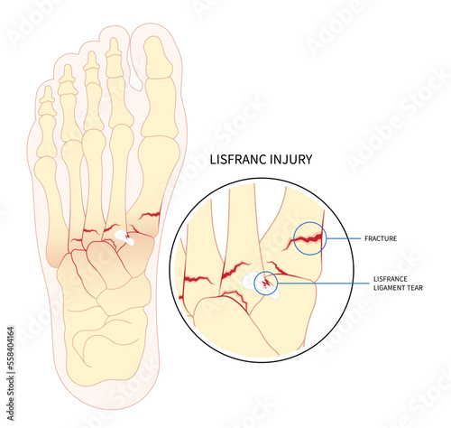 Foot bone painful displaced and Chopart's five trauma athletes heel density scan toes