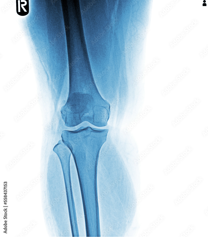 film x-ray AP ( anterior - posterior ) of knee show narrow joint space film x-ray AP ( anterior - posterior ) of knee show narrow joint space