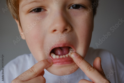 Closeup portrait of a kid showing his milk teeth, two rows