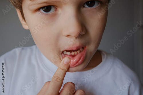 Closeup portrait of a kid showing his milk teeth  two rows