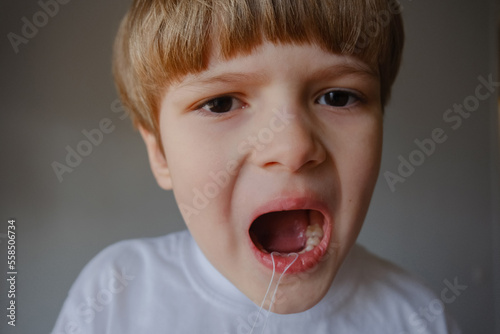 Closeup portrait of a kid removing his milk teeth, two rows