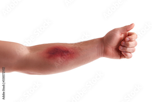 Male arm with bruise on white background