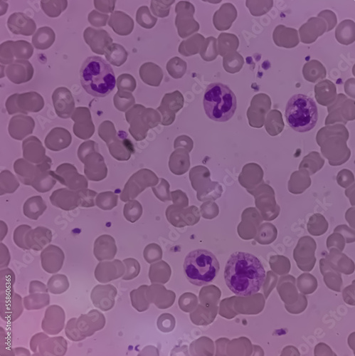 Microscopic finding, Neutrophilic leukocytosis with thrombocytosis, increase total count of White blood cell and increase number of neutrophils. photo