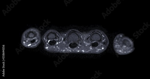 MRI hand T2W Fat suppression for diagnosis bone arthritis , rheumatoid and Tear of ligament. photo