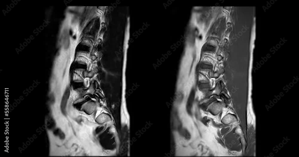 MRI L-S spine or lumbar spine sagittal T1W and T2W for diagnosis spinal ...