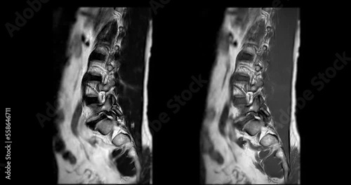 MRI L-S spine or lumbar spine sagittal T1W and T2W for diagnosis spinal cord compression. photo