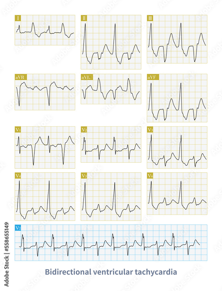 Bidirectional ventricular tachycardia is a kind of malignant arrhythmia. The polarity of QRS main wave alternates from beat to beat, and it is easy to degenerate into ventricular fibrillation.
