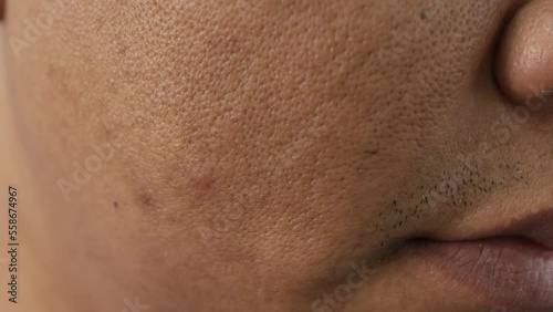 Cheeks of people with skin problems, acne, large pores and dull skin
