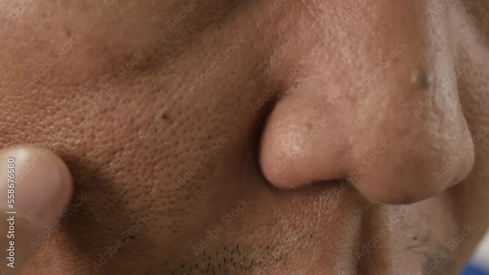 Cheeks of people with skin problems, acne, large pores and dull skin
