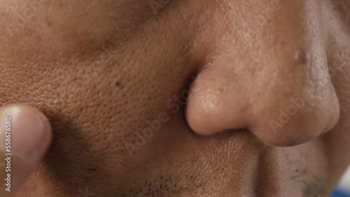 Cheeks of people with skin problems, acne, large pores and dull skin
