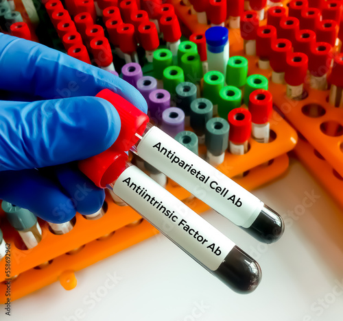 Antiparietal Cell Antibody and  Intrinsic Factor Ab to confirm a diagnosis of pernicious anemia.
