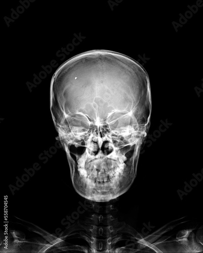 head skull x-ray front view