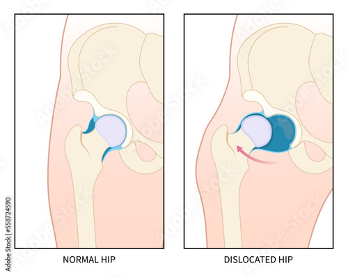 Chronic nerve compression in femur neck pelvis thighbone joint dislocated broken pain of leg bone treat prosthesis unstable damage baby birth sport sciatic labral tear child hurt thigh closed loose
