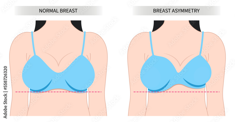 Malignant cyst woman breast lump implant sagging lift fat transfer large  mass size small shape one bigger than pain examine density milk gland duct  test Stock Vector