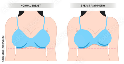 Malignant cyst woman breast lump implant sagging lift fat transfer large mass size small shape one bigger than pain examine density milk gland duct test photo